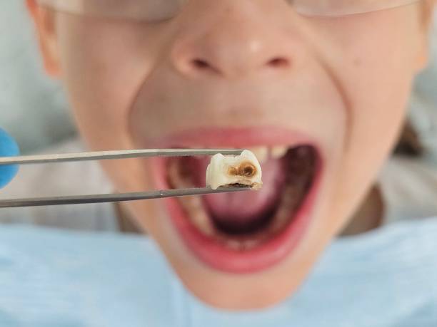 Best Emergency Wisdom Tooth Extraction in Chetek, WI